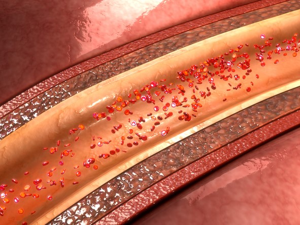 blood vessel calcification