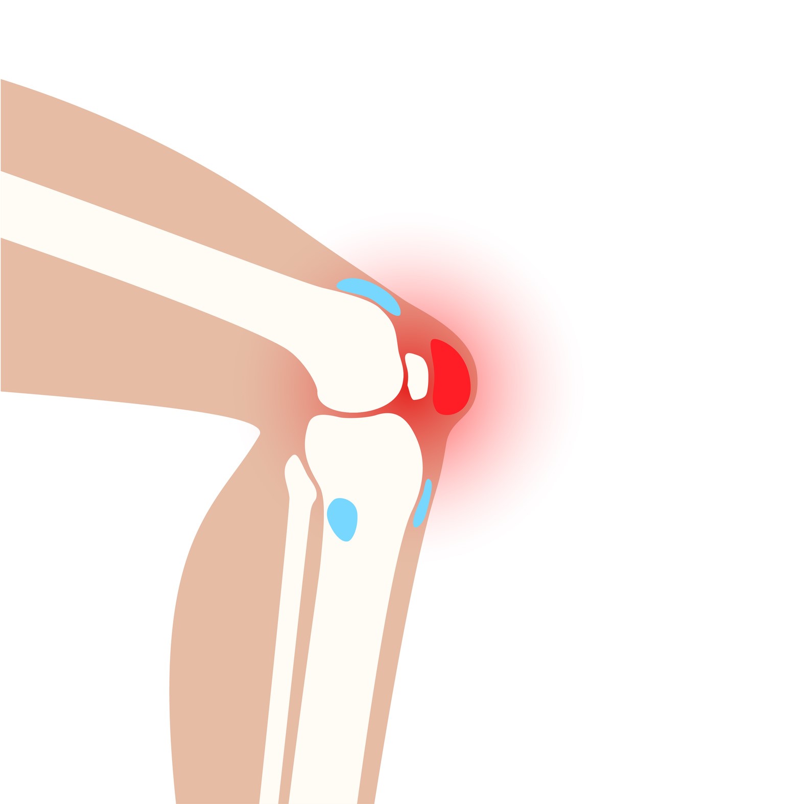 Kneecap bursitis